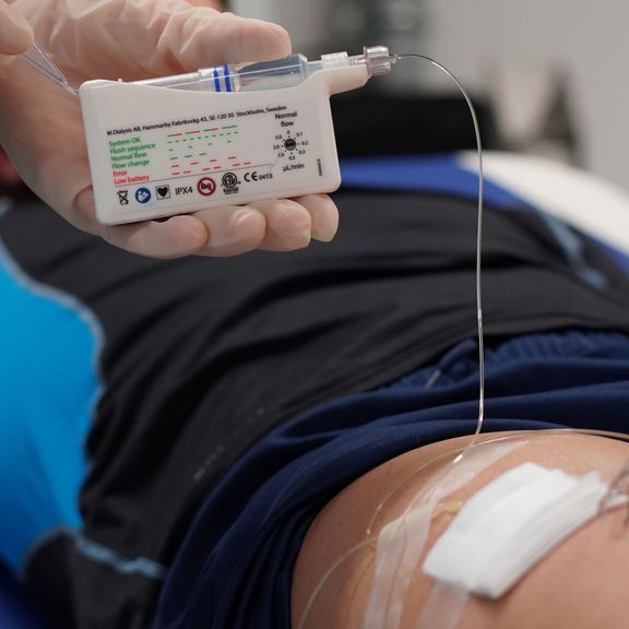 Hand hält medizinisches Mikrodialysegerät über Kanüle am Oberschenkel einer Person, Hintergrund unscharf
